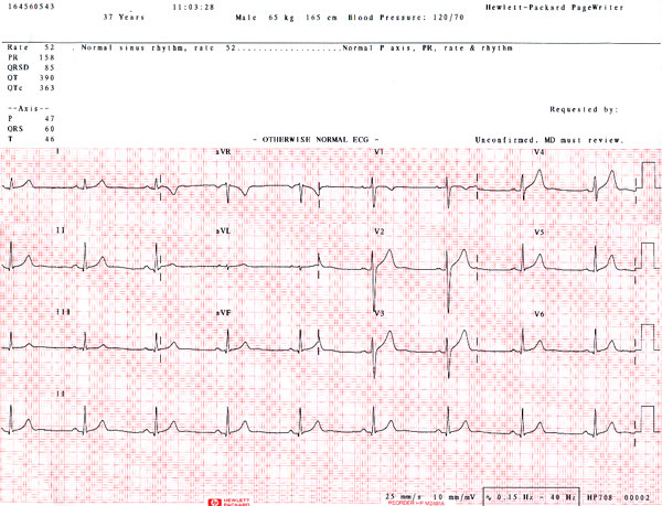 ecg