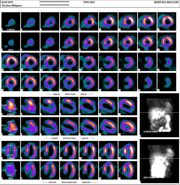 Myocardial Perfusion Imaging