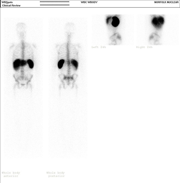 Indium 111 Leukocyte Scintigraphy for Suspected Infection 
      / Inflammation