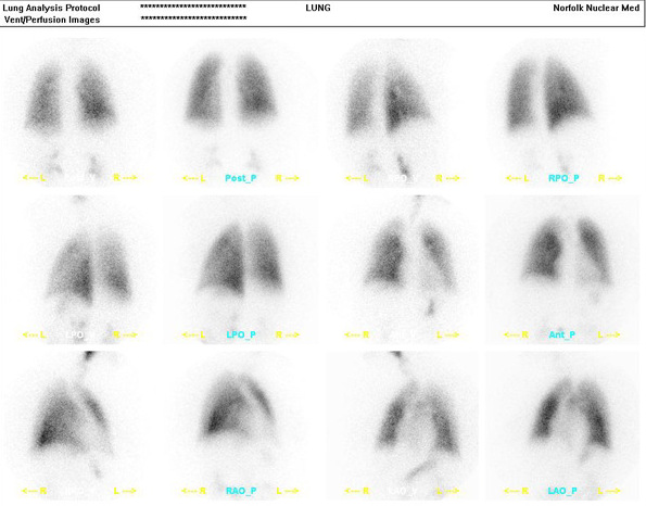 Ventilation-Perfusion Lung Scan