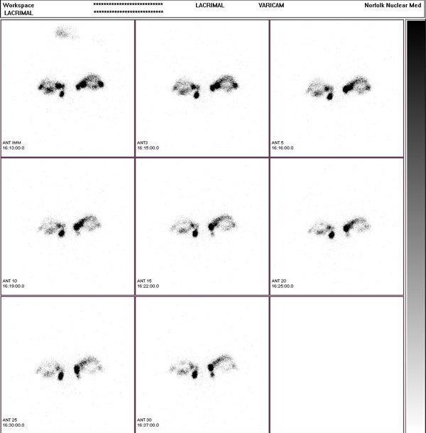 Lacrimal Scan