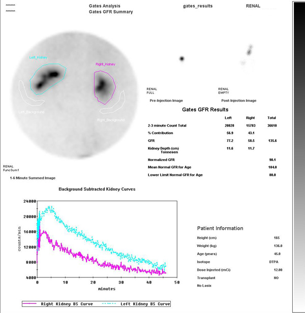 Renal Scan