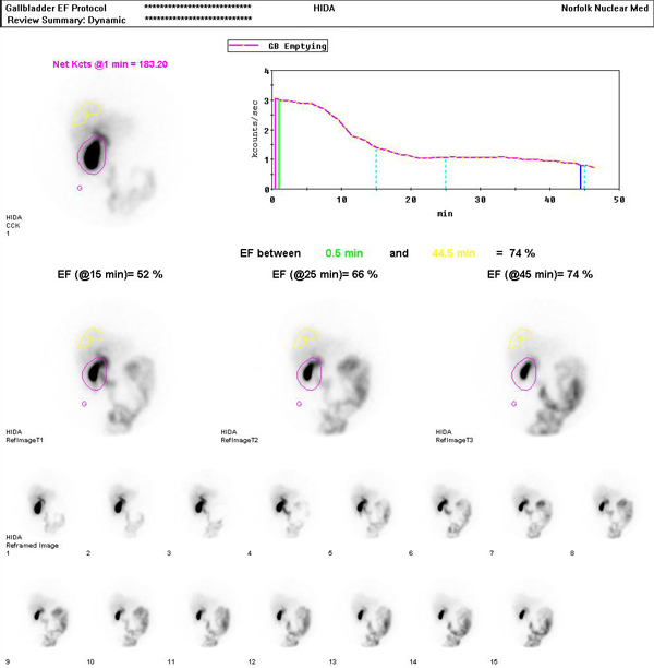 Biliary (hida) Scan