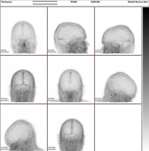 Brain Scintigraphy