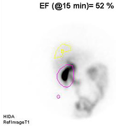 Biliary (Hida) Scan