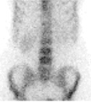 Bone Scan