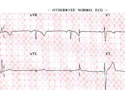 ECG