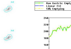 Gastric Emptying Study