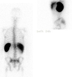 Indium111 Labeled White Cells