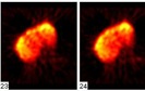 Liver SPECT Scan