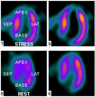 Myocardial Perfusion