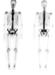 Bone Scan