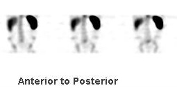 TC99M HMPAO Labelled Leukocyte Scintigraphy