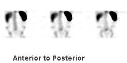 TC99M HMPAO Labelled Leukocyte Scintigraphy